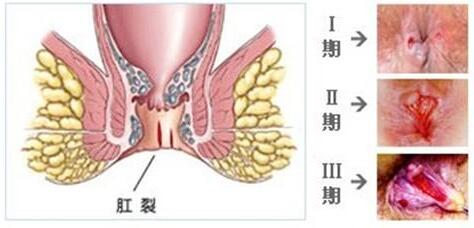 預(yù)防肛裂復(fù)發(fā)