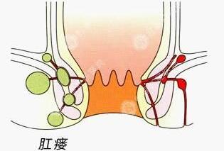 合肥治療肛瘺 合肥肛腸醫(yī)院