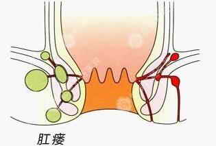 肛瘺疾病 肛瘺常識(shí)